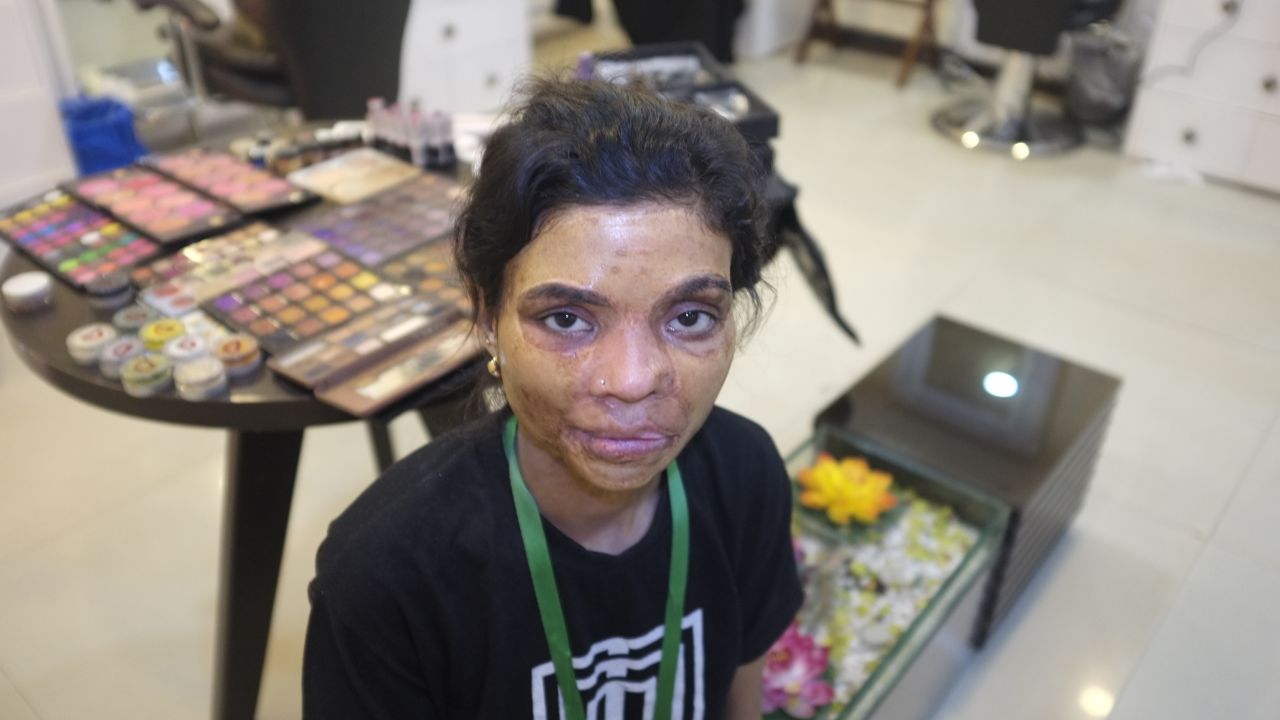 Salma Arif endured painful skin grafts. She was three years old when she was attacked with acid.