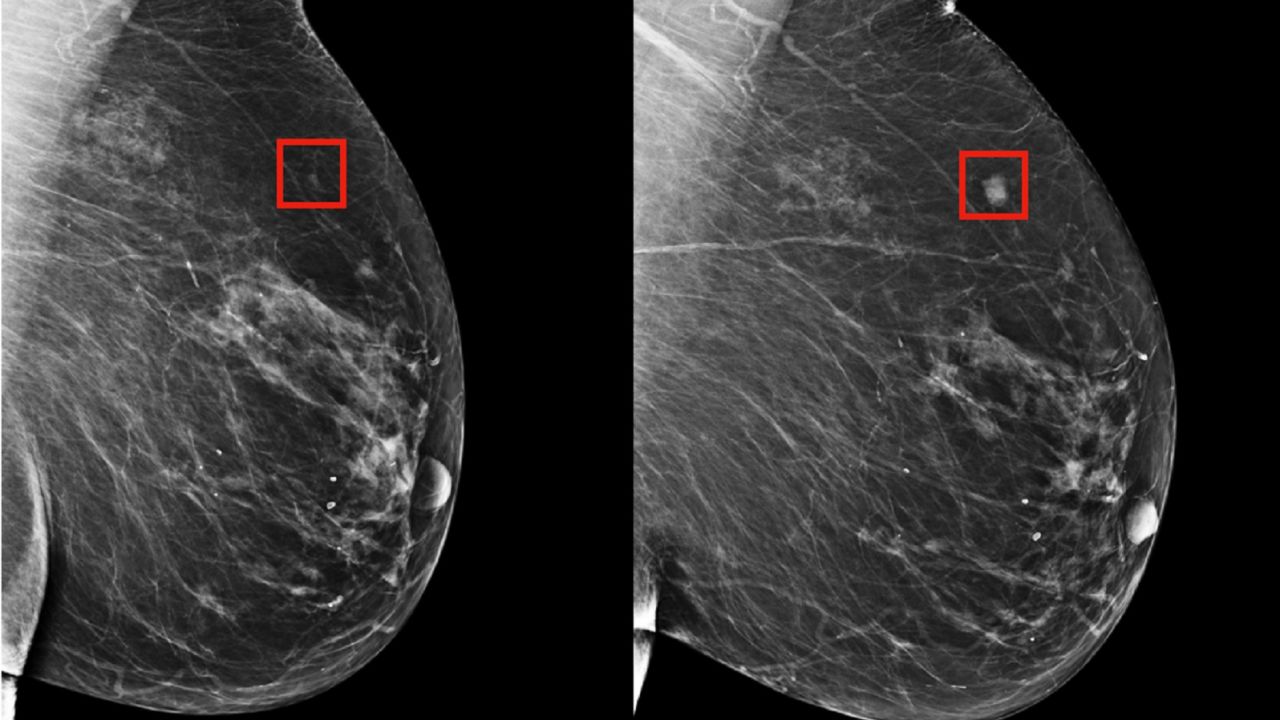 An algorithm, developed by MIT researchers, could identify a woman's risk of breast cancer and help to catch it early