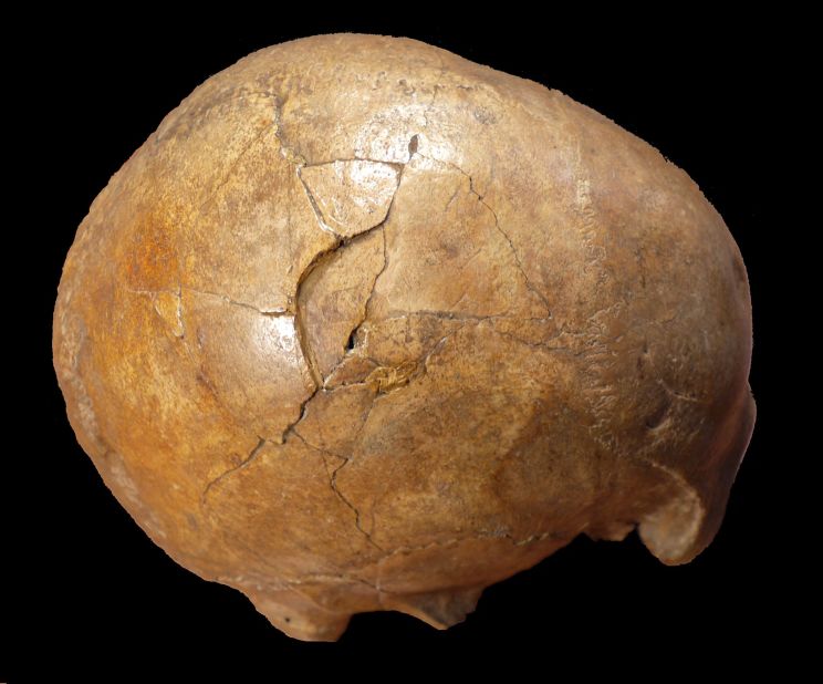 A 33,000-year-old human skull shows evidence of being struck with a club-like object. The right side of the man's head has a large depressed fracture.