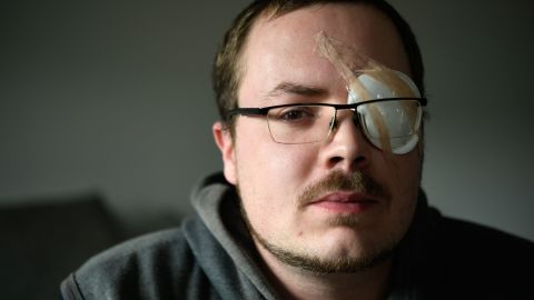 Gwendal Leroy is unemployed and believes his eye injury will be used against him when applying for jobs. 
