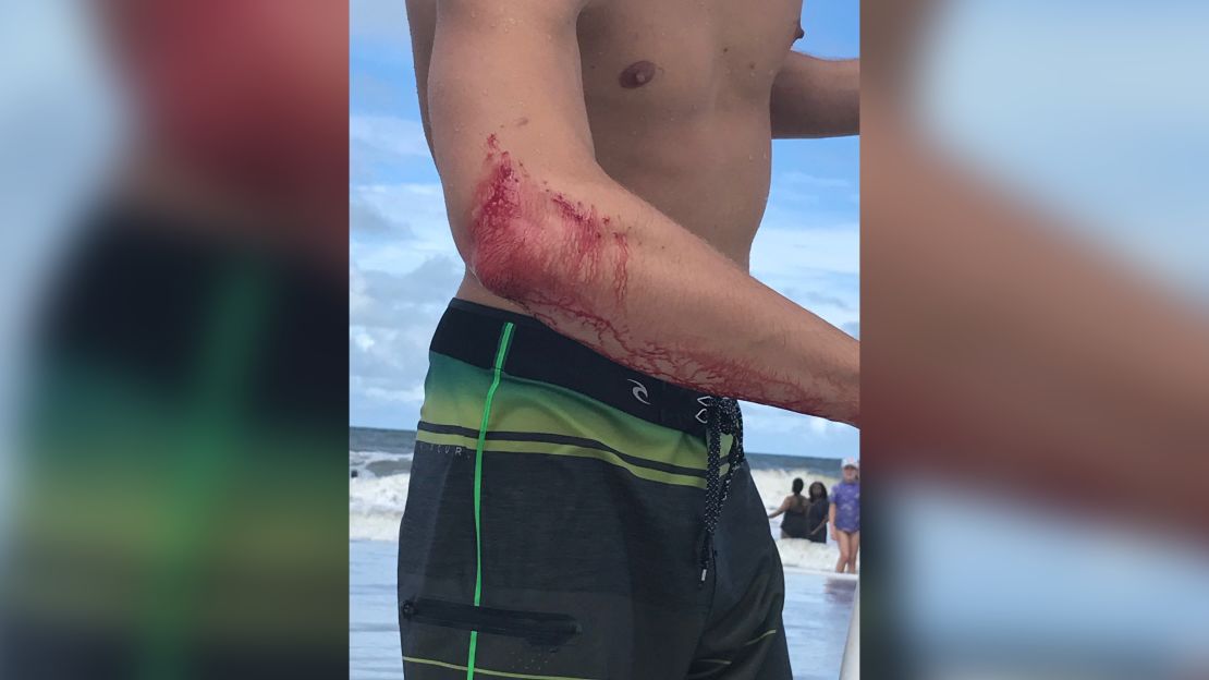 Professional surfer Frank O'Rourke shows off the bite mark on his arm. 