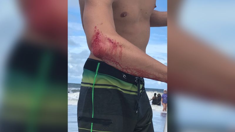 Florida surfer bitten by shark near Jacksonville Beach | CNN