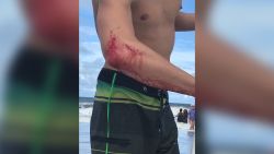 Professional surfer Frank O'Rourke was bitten by a shark in the waters off Jacksonville Beach Pier Saturday.