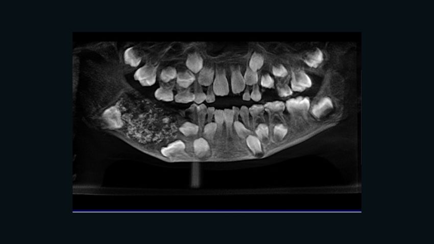 An x-ray of the boy's mouth