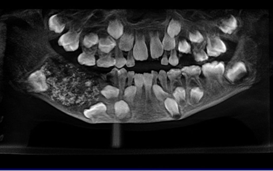 An x-ray of the boy's mouth shows the sac.