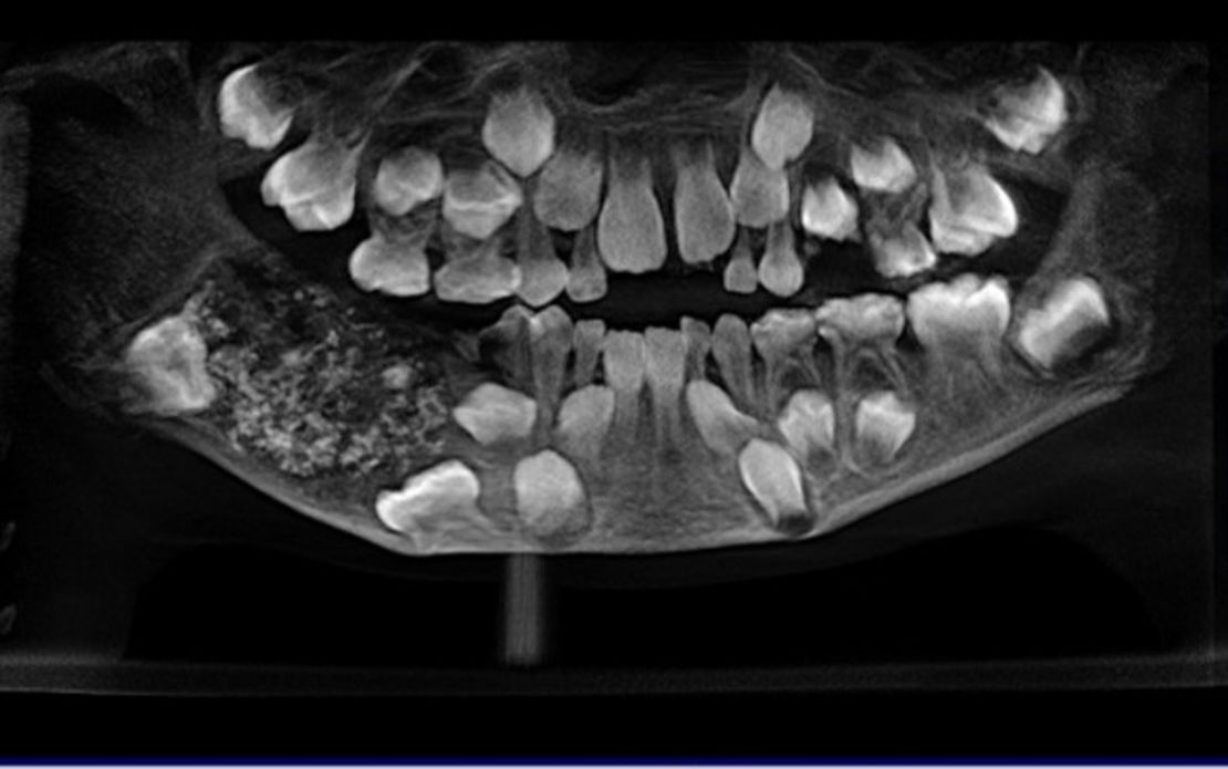 02 india boy teeth