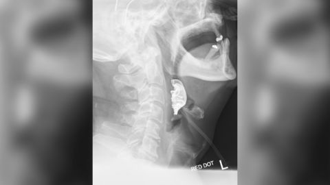 The X-ray showed a semicircular object lying across the man's vocal cords.