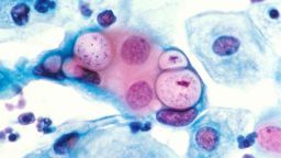 Human pap smear showing chlamydia in the vacuoles at 500x and stained with H&E. (Photo by: Media for Medical/Universal Images Group via Getty Images)