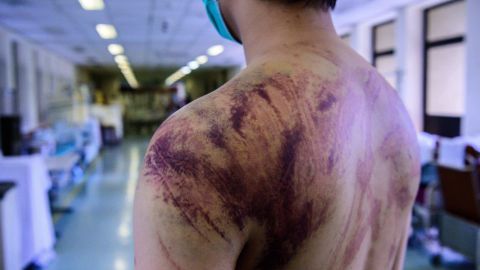 Calvin So, 23, a resident of Yuen Long, a Hong Kong town near the border with mainland China, shows his wounds and bruises on July 24, 2019, after he was assaulted on his way home by a gang of men.