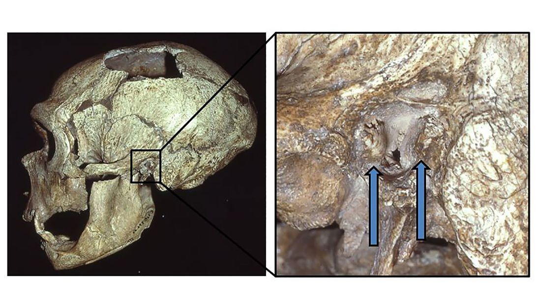 The La Chapelle-aux-Saints Neanderthal skull shows signs of external auditory exostoses, known as "surfer's ear" growths, in the left canal.