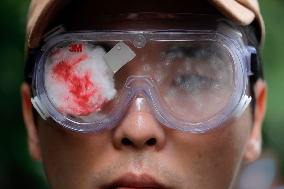 A protester participates in a march on Saturday, August 17. His eye is covered with red gauze, referencing a woman who was allegedly shot in the eye with a beanbag round during clashes between protesters and police.
