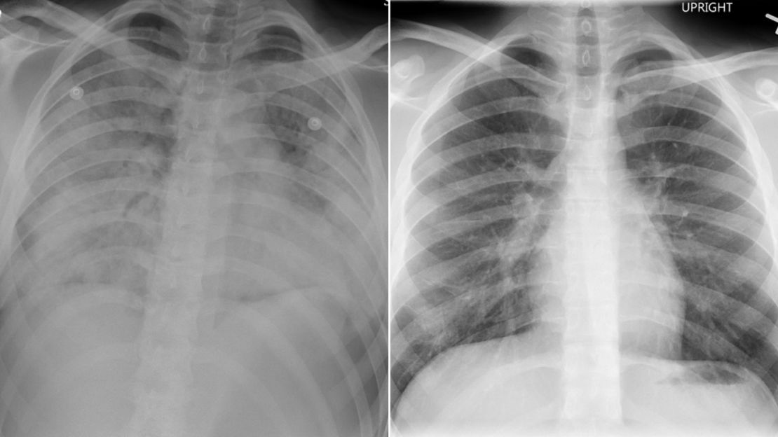 Tryston's lungs showed signs that looked like pneumonia. The image on the left was taken 36 hours after he arrived at the hospital. The scan on the right was taken the day he was discharged and shows improvement.