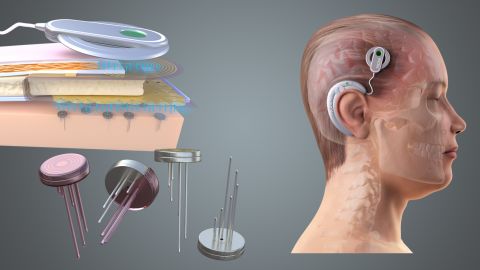 Neural interfaces may offer a new way of treating conditions including dementia, paralysis, mental health conditions or obesity, according to new research.