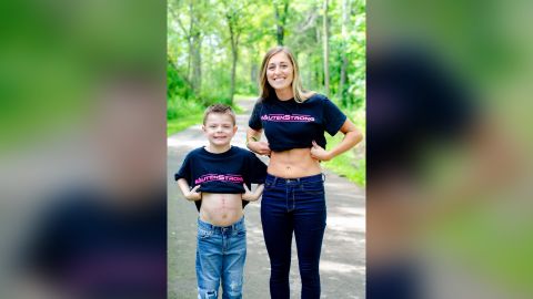 Auten posing with Loritz showing off the scars from their surgeries.