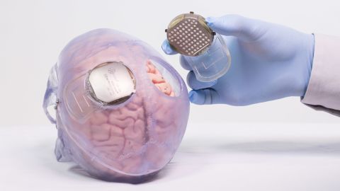 Recording devices were implanted on either side of Thibault's head, between the skin and the brain.