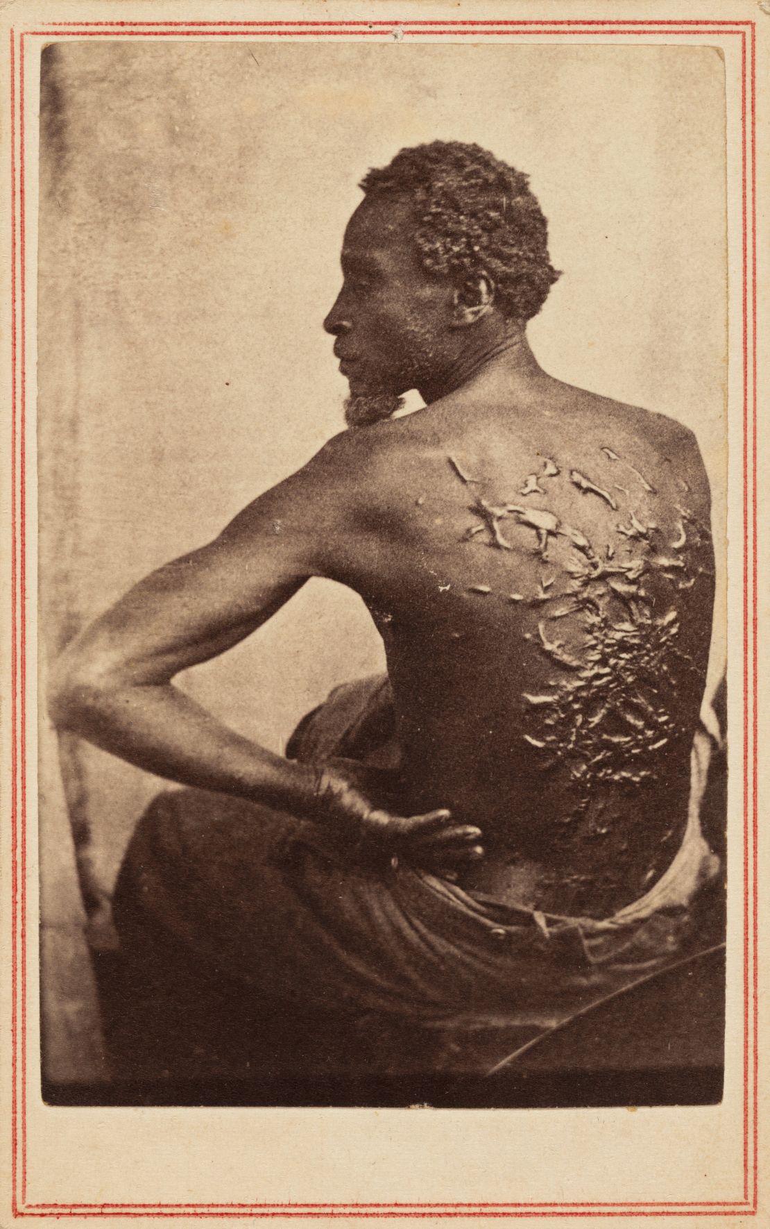 Taken around 1863, and attributed to a duo known as McPherson & Oliver, "The Scourged Back" depicts a man with scars from whippings he'd received as a slave.