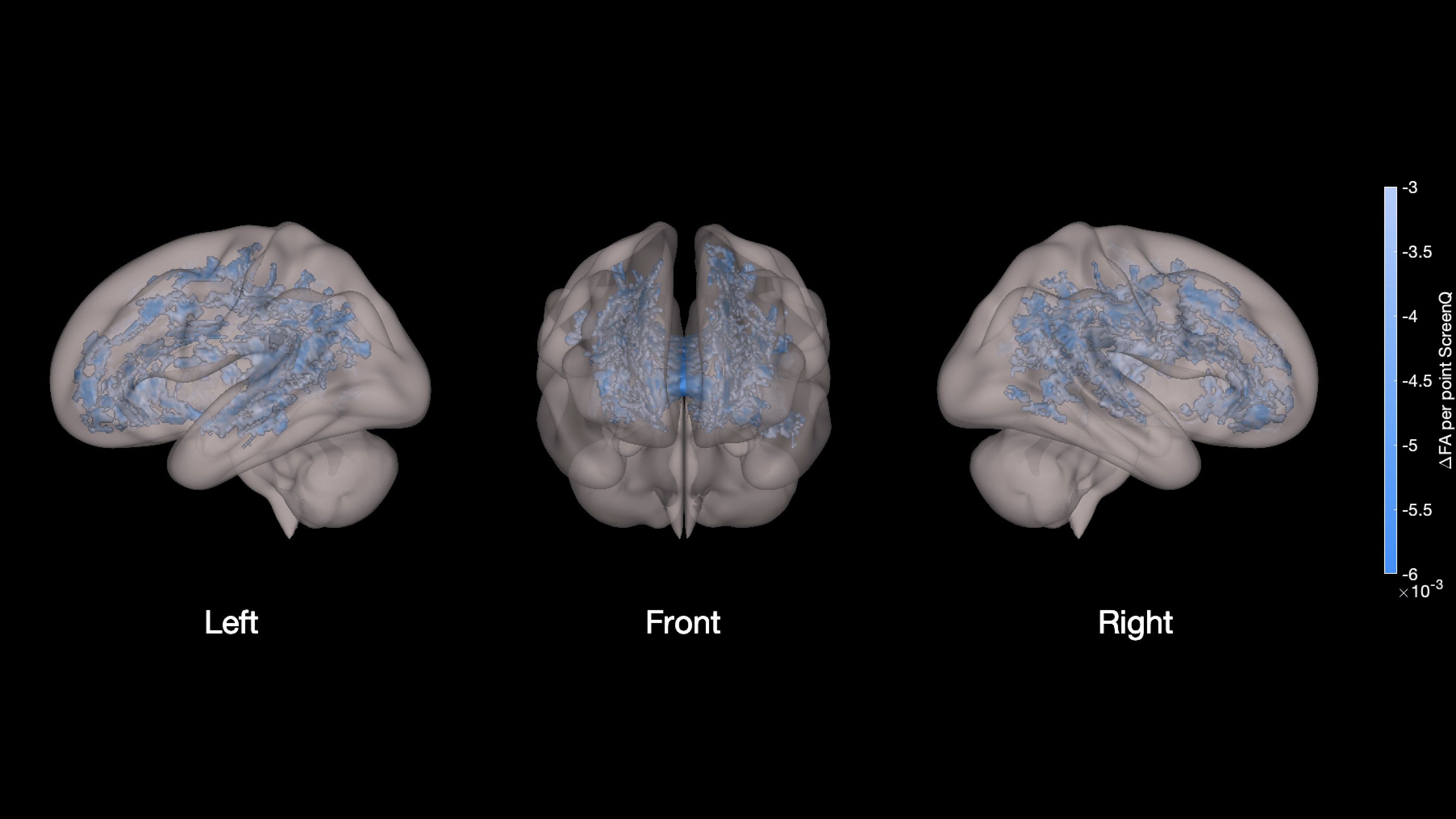 Higher screen use was associated with less well-developed white matter tracts (shown in blue in the image)  throughout the brain.
