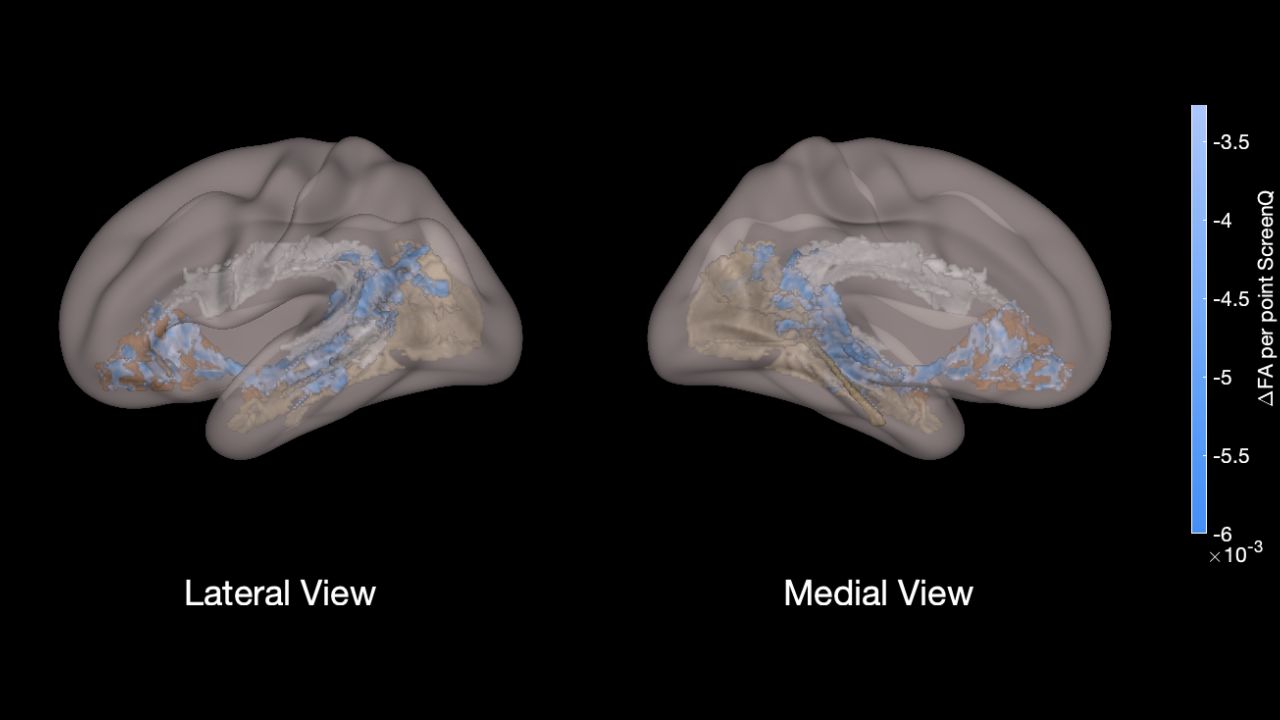 This view shows the three major tracts involved with language and literacy skills: the arcuate fasciculus, shaded in white, which connects brain areas involved with receptive and expressive language. The one in brown supports rapid naming of objects, and the one in beige, visual imagery. The blue color illustrates lower measures of white matter development in children using excessive screen time.