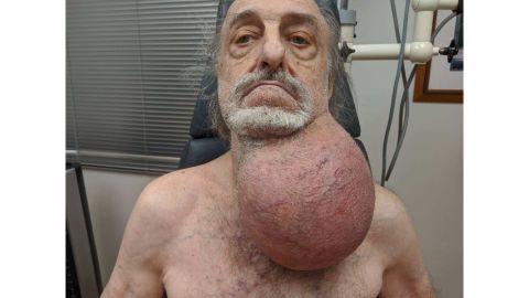 The man's tumor as seen before surgery.