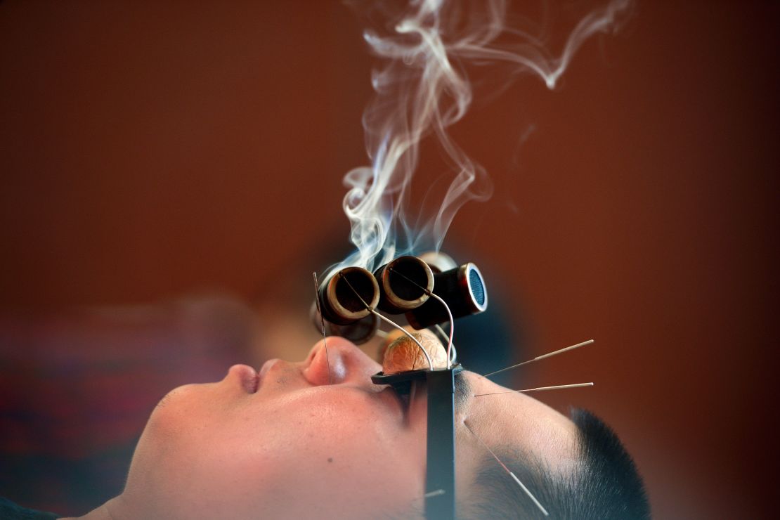A man wearing "walnut" glasses is treated with smoking wormwood to relieve his oculomotor paralysis at a hospital on July 13, 2018 in Jiaxing, Zhejiang Province of China. 