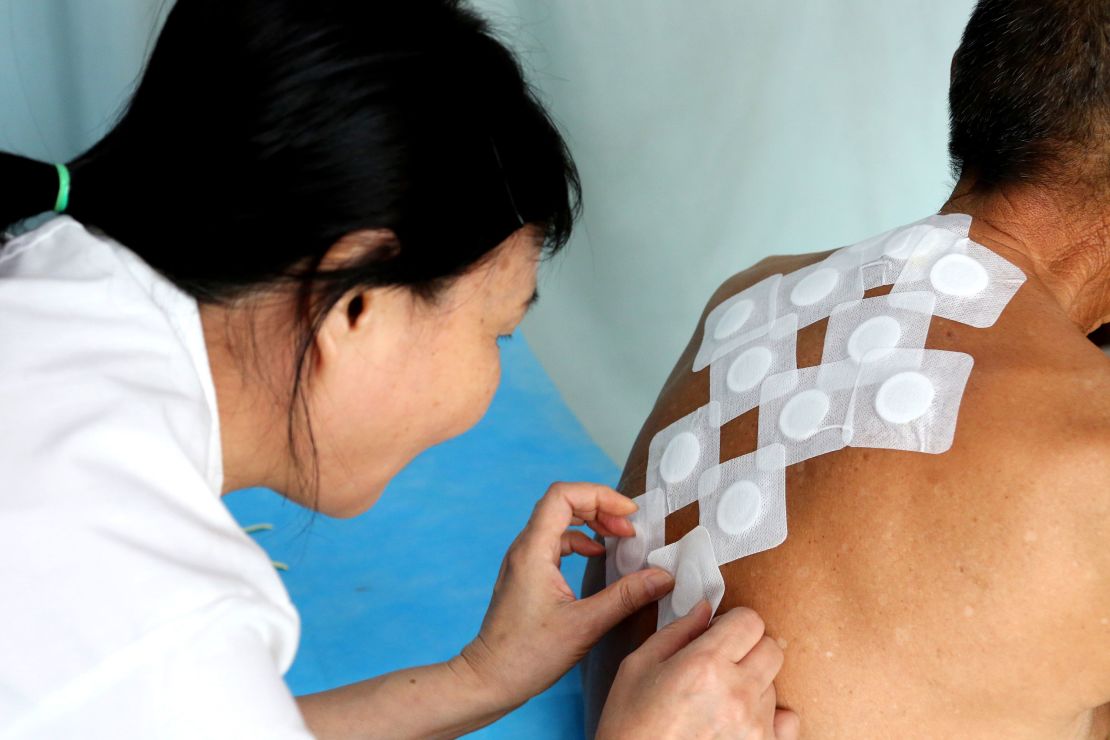 A patient receives treatment with bandages filled with herbs at a Traditional Chinese Medicine hospital on July 12, 2019 in Zaozhuang, Shandong Province, China.