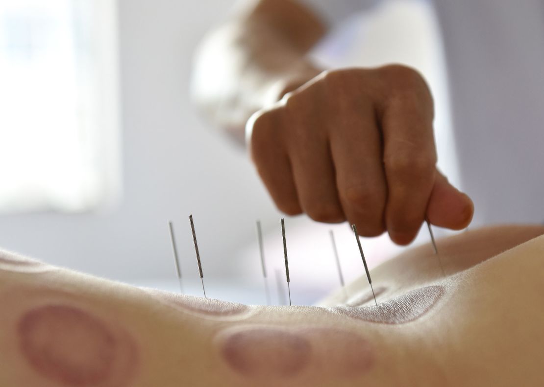 Acupuncture therapy in Hong Kong was linked to organ and tissue injuries, infection and other adverse reactions by a 2018 study.