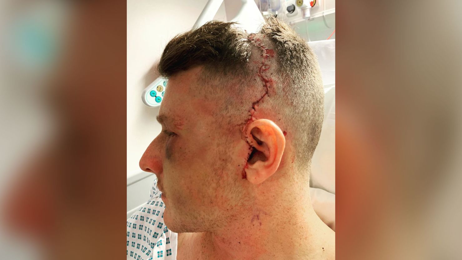 Ward had 31 staples removed from his head on Monday.