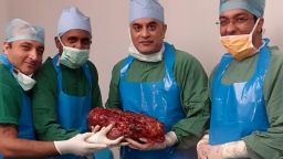 Doctors of Sir Ganga Ram Hospital, in New Delhi, claimed to have removed India's heaviest kidney weighing 7.4 kilograms.