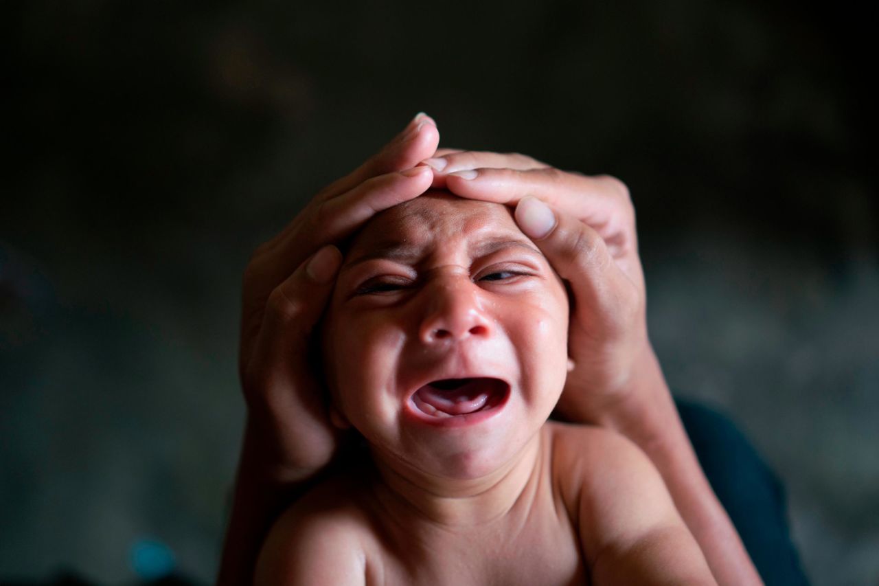 Jose Wesley, a baby born with microcephaly, cries in Bonito, Brazil, in January 2016. Microcephaly is a neurological disorder that results in newborns with small heads and abnormal brain development. <a href="http://www.cnn.com/2016/01/26/health/gallery/zika-virus/index.html" target="_blank">An outbreak of the Zika virus</a> was linked to a surge of babies with the birth defect.