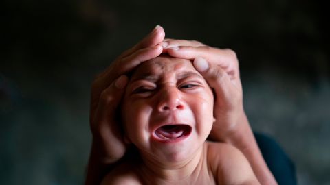 Jose Wesley, a baby born with microcephaly, cries in Bonito, Brazil, in January 2016. Microcephaly is a neurological disorder that results in newborns with small heads and abnormal brain development. <a href="http://www.cnn.com/2016/01/26/health/gallery/zika-virus/index.html" target="_blank">An outbreak of the Zika virus</a> was linked to a surge of babies with the birth defect.