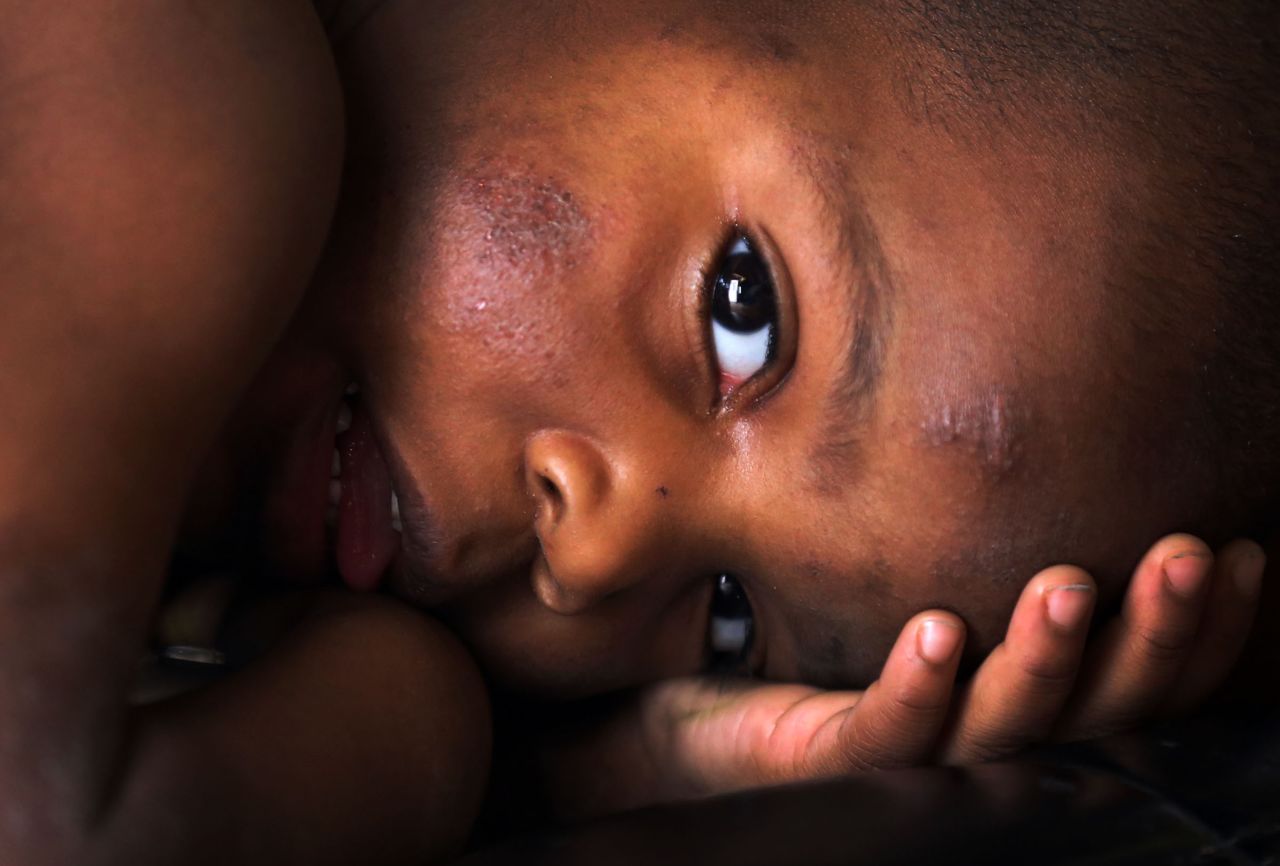 Sincere Smith, a 2-year-old from Flint, Michigan, suffers from a full-body rash that his mother blamed on municipal water he bathed in. <a href="https://www.cnn.com/specials/us/flint-water-crisis" target="_blank">Cost-cutting measures in Flint led to tainted water</a> that contained lead and other toxins.