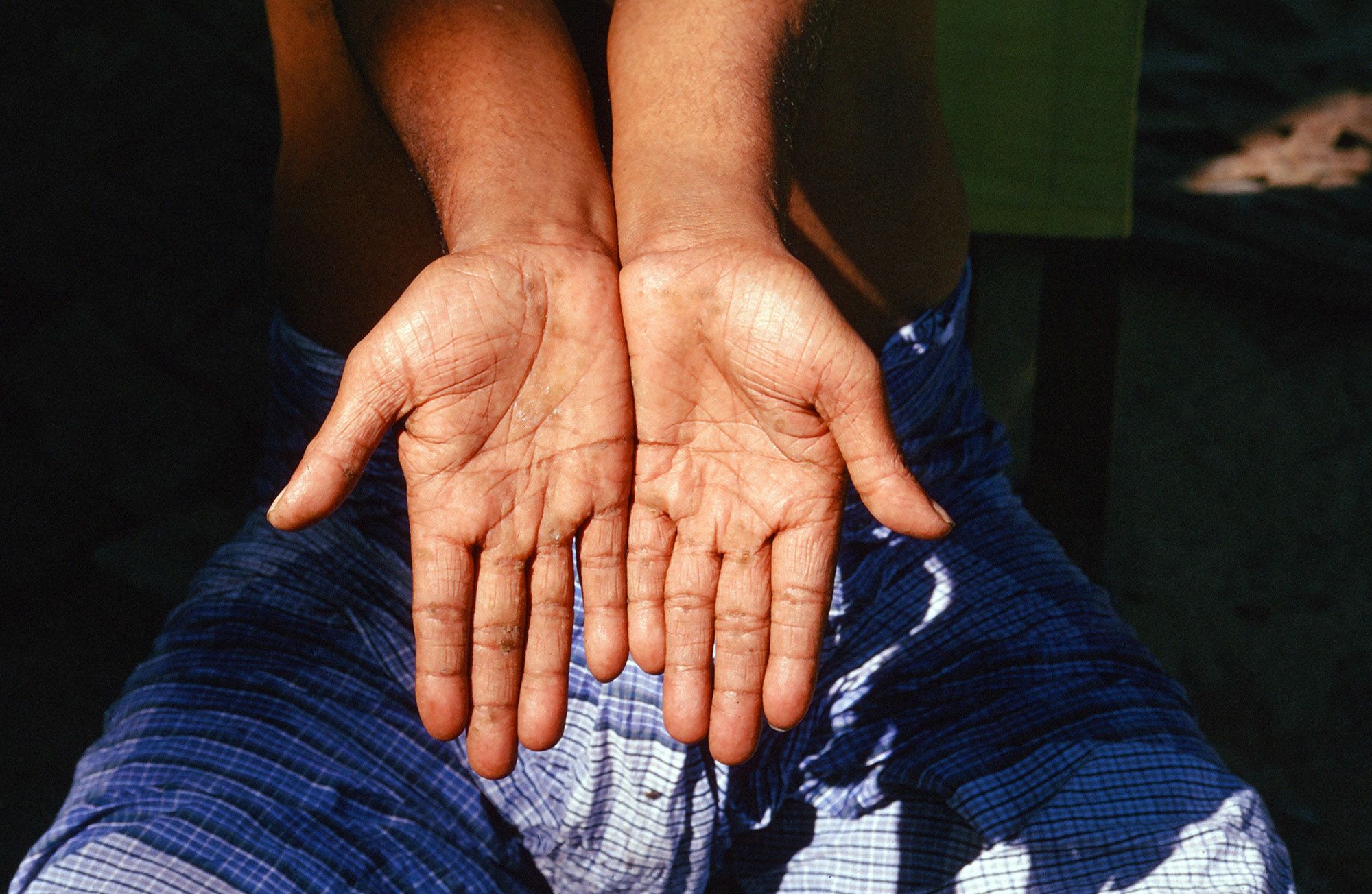A Bangladeshi man with keratosis, hard growths on the palms of his hands that are a sign of arsenic poisoning. The photo was taken as part of a large-scale research project between 1998 and 1999.