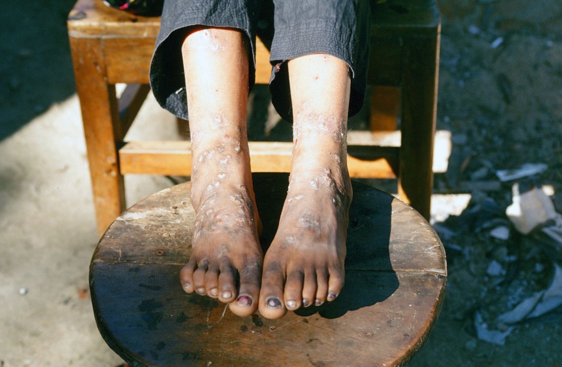 A patient in Bangladesh with "blackfoot disease," associated with long-term exposure to arsenic.