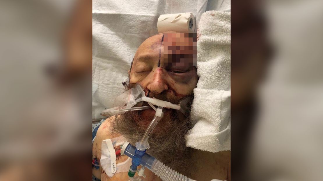 Josef Neumann's daughter says the family released this photo to show the brutality of the anti-Semitic attack.