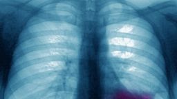 Lung cancer on the left pulmonary lobe, seen on a frontal x-ray of the chest. (Photo by: BSIP/Universal Images Group via Getty Images)