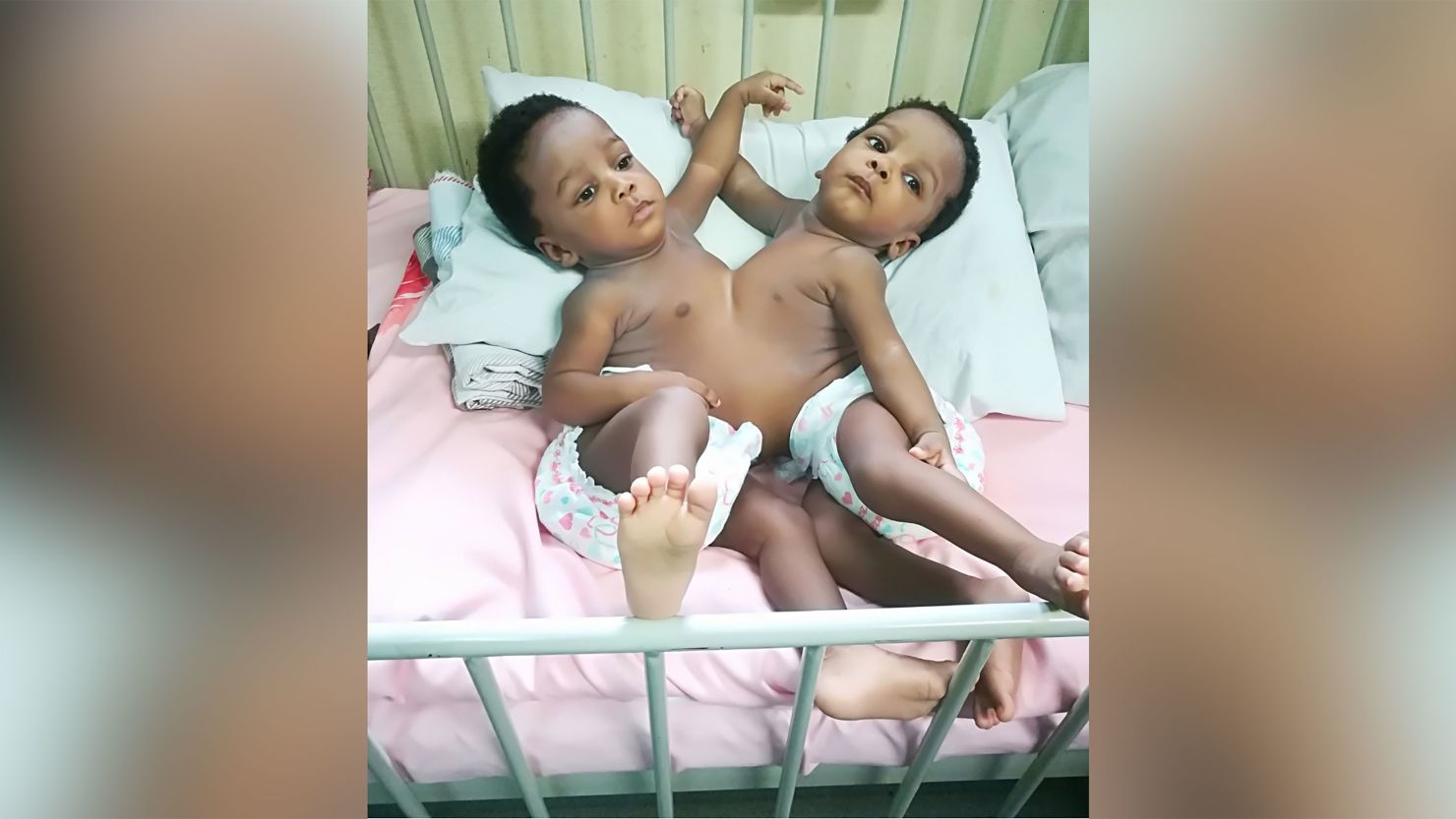 01 Nigerian conjoined sisters separated