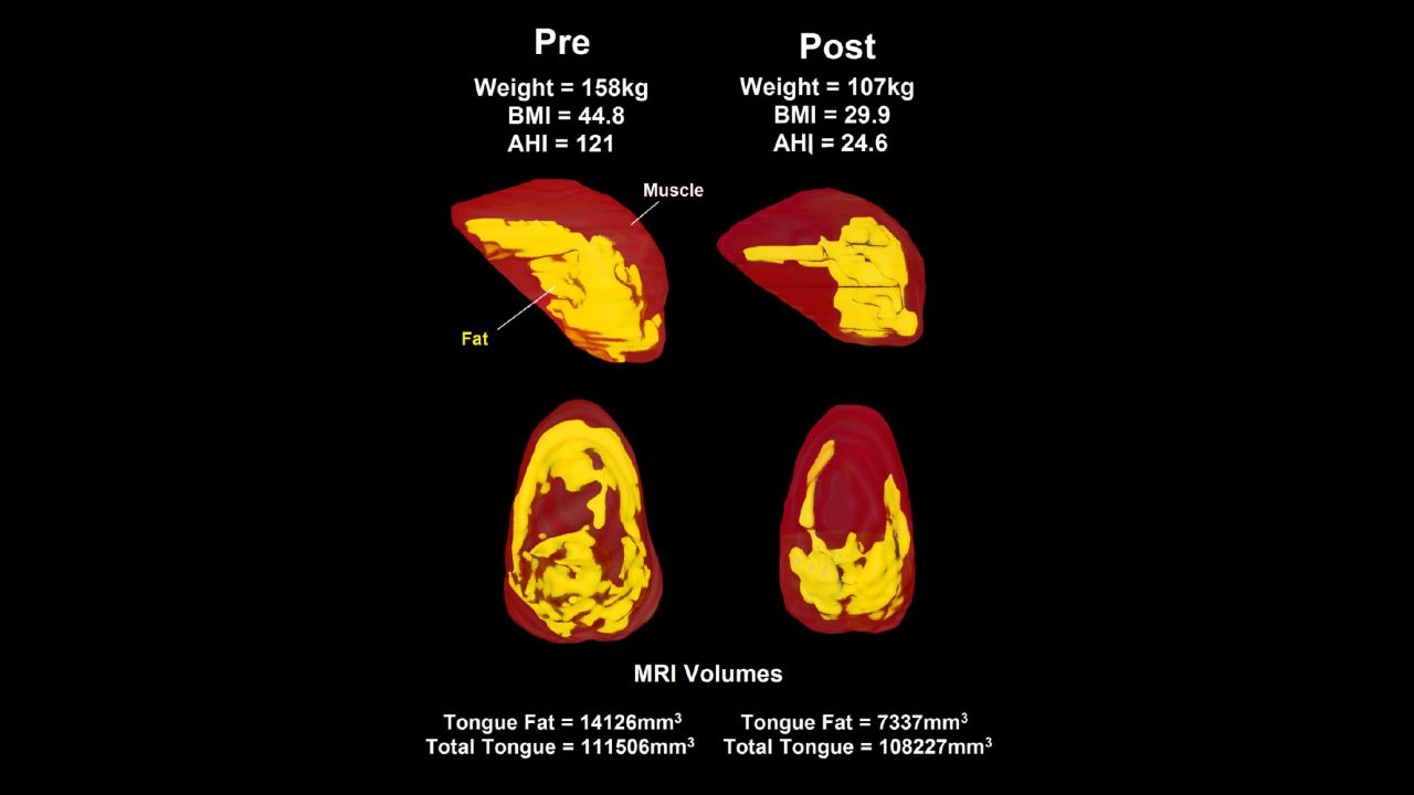 MRI's on the left show levels of fat (in yellow) before weight loss. The images on the right show decreased levels of fat after a 10% overall weight loss.