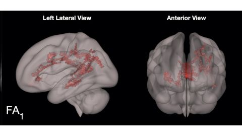 The red shows the increase in organzied white matter in the language centers of the  preschooler's brain.
