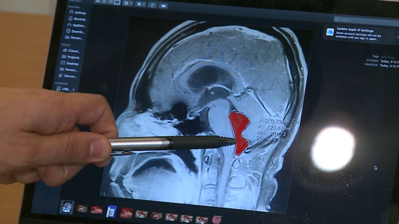 The lesion in Gerardo Moctezuma's brain was caused by tapeworm larvae. They'd likely lived in his body for years, Dr. Jordan Amadio said.