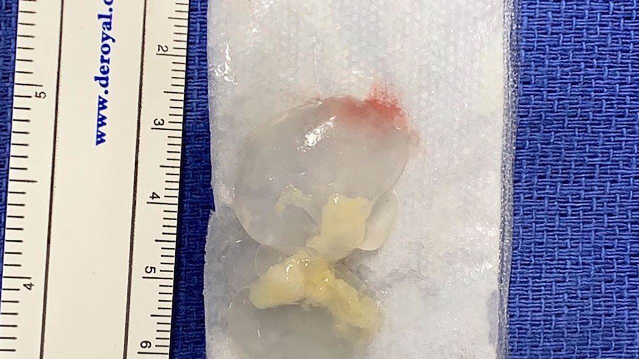 The tapeworm after it was removed.