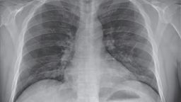 Stable streaky opacities in the lung bases were visible, indicating likely typical pneumonia; the opacities have steadily increased in density over time.