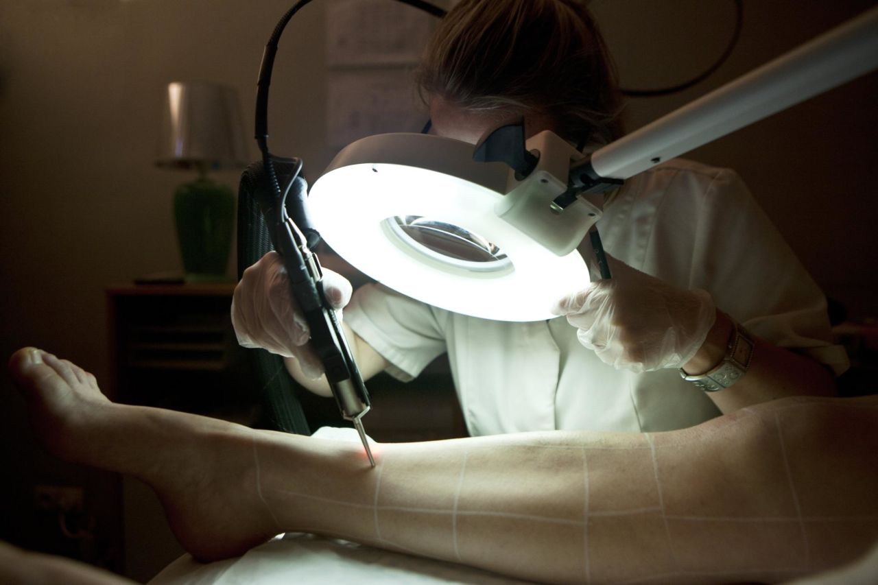 In Paris, a patient undergoes a hair removal session using an Alexandrite laser. 