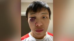 Jonathan Mok said he was attacked in London, causing injury to his right eye. He posted two photos of his face on social media, explaining: "One image was taken in the mirror and hence, the laterally inverted image. The image that seems so be much swollen was taken as a selfie-- and the bruising only developed in the following day."