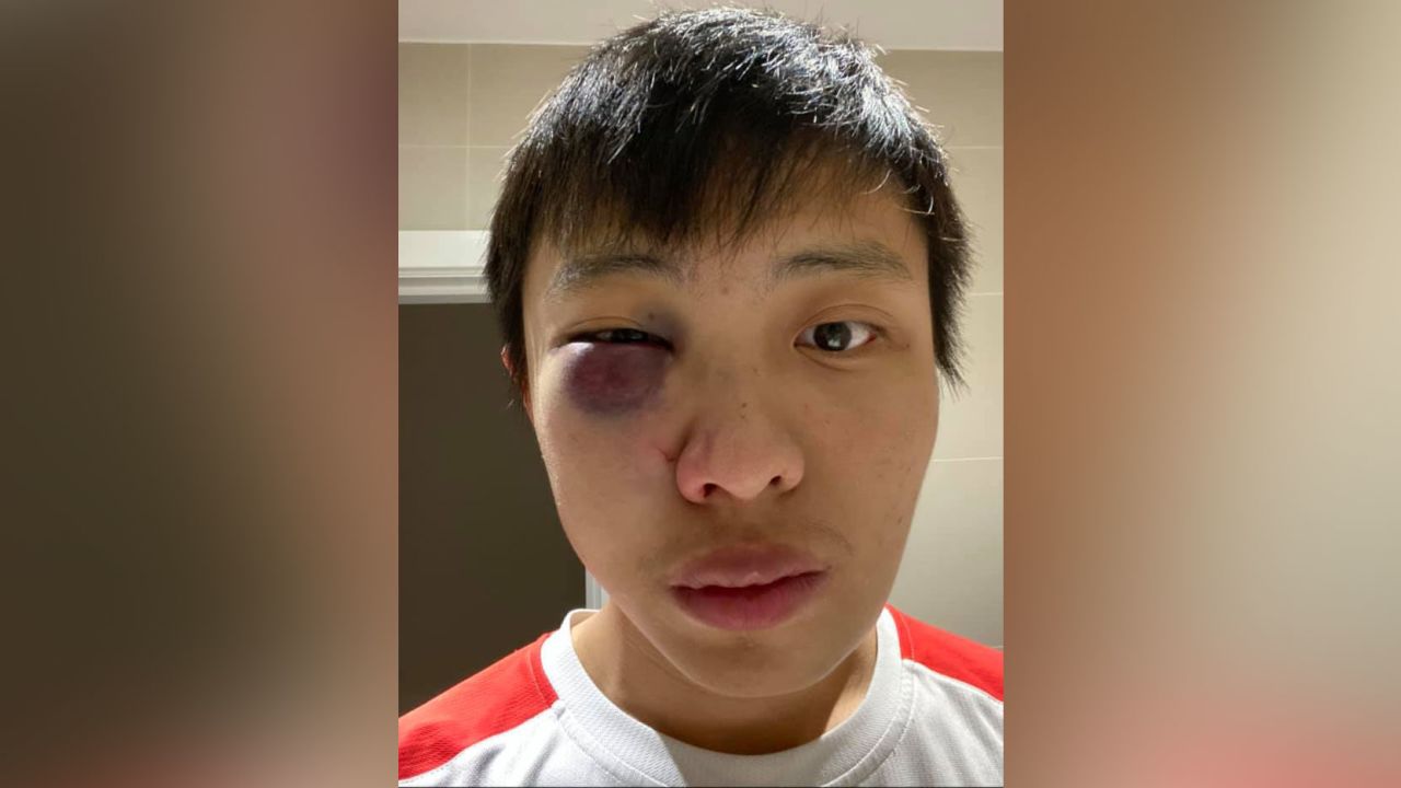Jonathan Mok said he was attacked in London, causing injury to his right eye. He posted two photos of his face on social media, explaining: "One image was taken in the mirror and hence, the laterally inverted image. The image that seems so be much swollen was taken as a selfie-- and the bruising only developed in the following day."
This photo was taken the day after the assault.