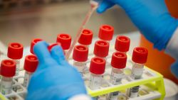 A laboratory technician prepares COVID-19 patient samples for semi-automatic testing at Northwell Health Labs, Wednesday, March 11, 2020, in Lake Success, N.Y. The US Food and Drug Administration has approved faster testing protocols as the viral outbreak continues to spread worldwide. For most people, the new coronavirus causes only mild or moderate symptoms. For some it can cause more severe illness. (AP Photo/John Minchillo)