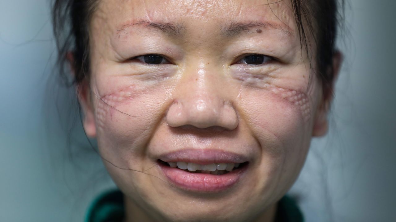 The marks of a mask are seen on the face of nurse Cao Shan after working in the isolation ward in Jinyintan Hospital, designated for Covid-19 patients, in Wuhan, China.