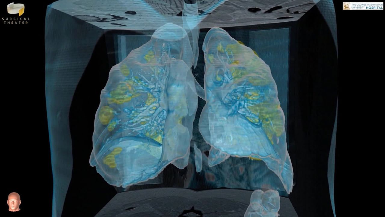 15943252: 3D Coronavirus Patients Lungs [Washington, D.C., U.S.]
A top hospital in Washington, D.C. has released the first images of a coronavirus patient's lungs, in an unprecedented 3D video.
The imagery shows extensive damage to an otherwise healthy, 59-year-old male who was asymptomatic until two to three days ago, said Keith Mortman, the chief of thoracic surgery at George Washington University Hospital. Now, as his lungs are failing, the patient requires a machine to help him breathe.