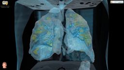 15943252: 3D Coronavirus Patients Lungs [Washington, D.C., U.S.]
A top hospital in Washington, D.C. has released the first images of a coronavirus patient's lungs, in an unprecedented 3D video.
The imagery shows extensive damage to an otherwise healthy, 59-year-old male who was asymptomatic until two to three days ago, said Keith Mortman, the chief of thoracic surgery at George Washington University Hospital. Now, as his lungs are failing, the patient requires a machine to help him breathe.
