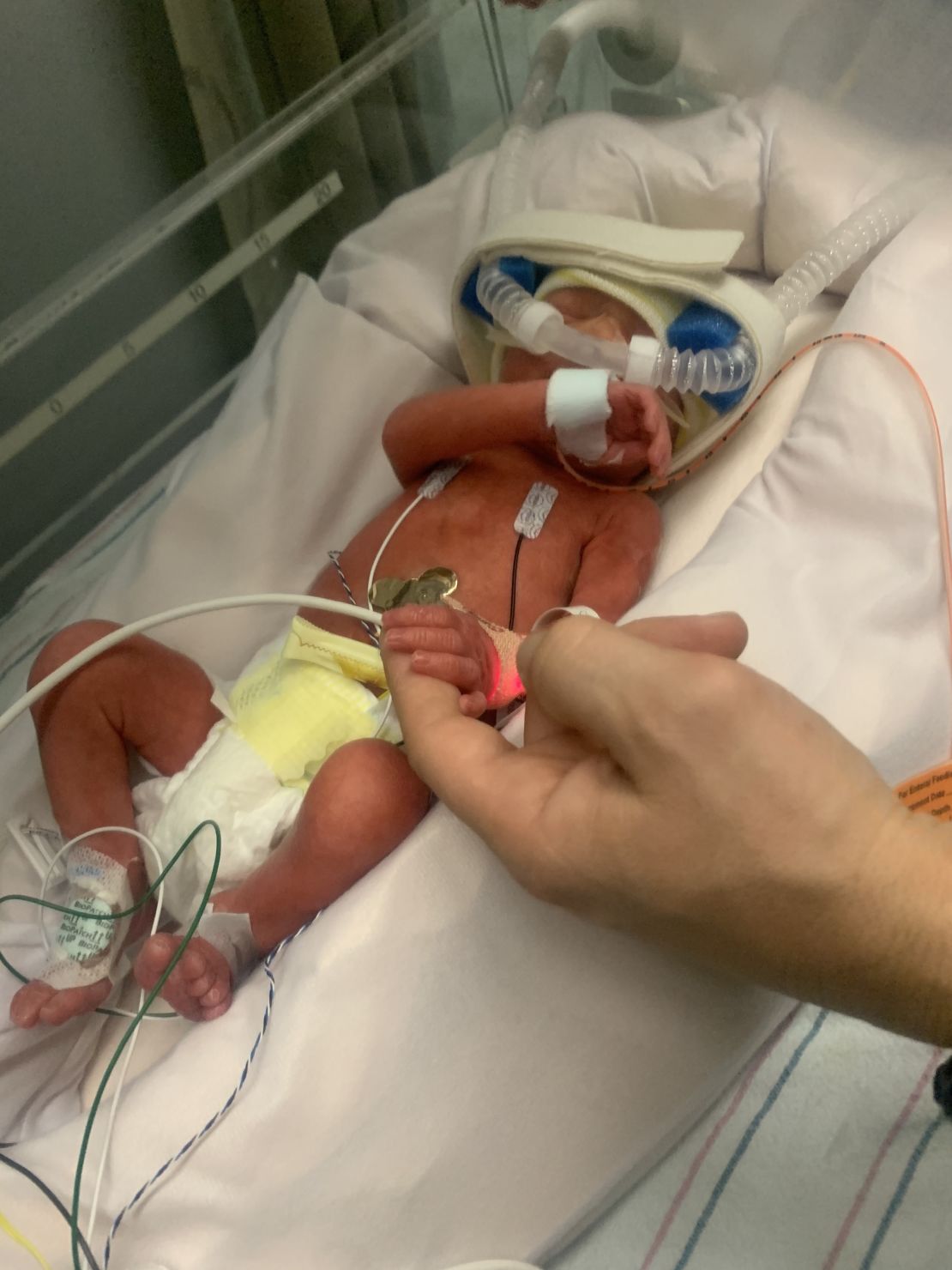 Doctors took Nicolas Mateo Flores to the neonatal intensive care unit as soon as he was born. 