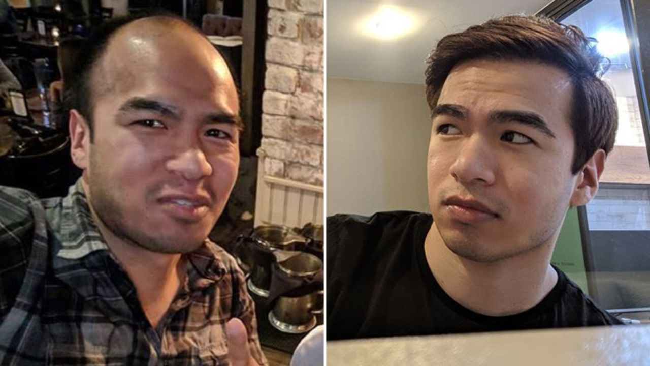 Chinese American Saul Trejo, pictured before and after undergoing a hair transplant in Thailand.